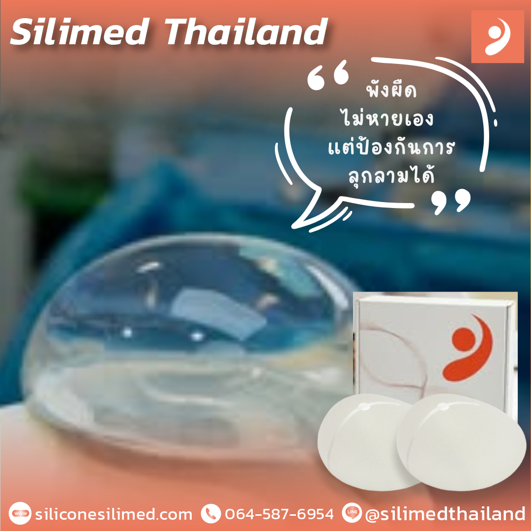 พังผืดสามารถหายเองได้ไหมถ้าไม่รุนแรง? พังผืดสามารถหายเองได้ไหมถ้าไม่รุนแรง?